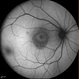 Chronic Central Serous Chorioretinopathy Chronic Central Serous Chorioretinopathy